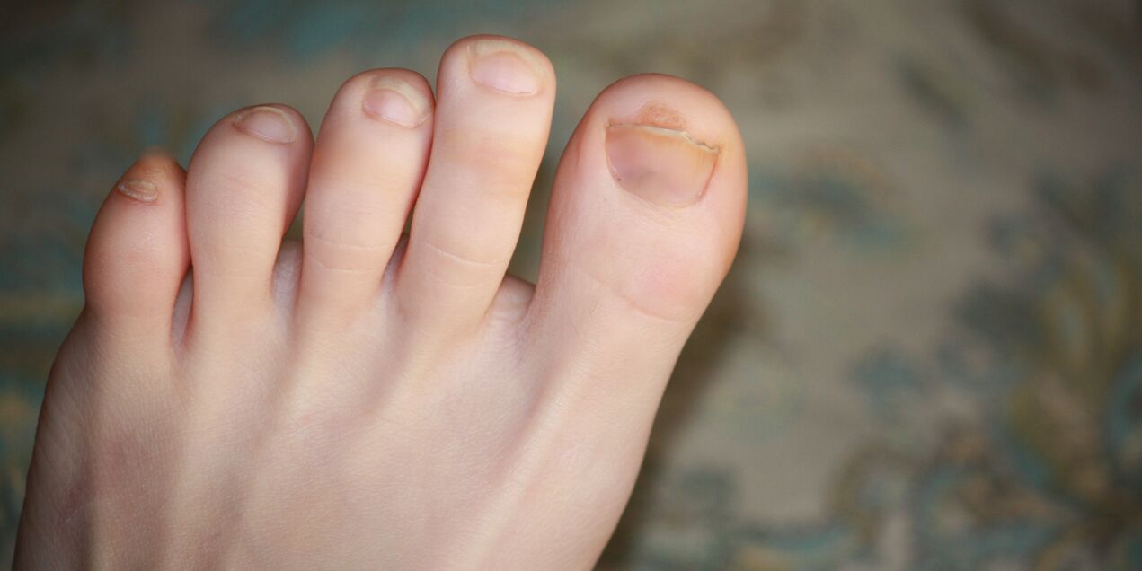 un picior poate răni cu ciuperca unghiilor
